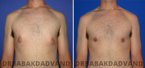 Before and After Photos. Gynecomastia.